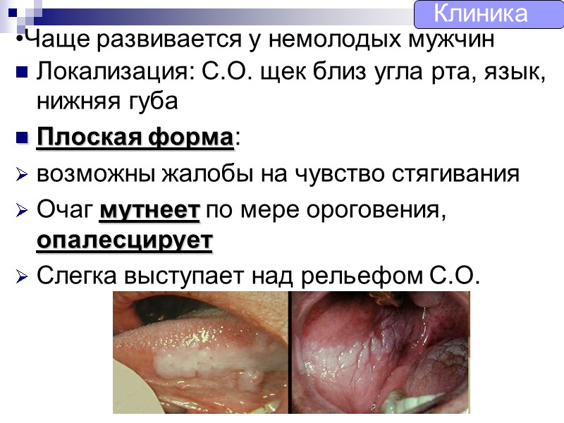 Чаще развивается у немолодых мужчин  Локализация: С.О. щек близ угла рта, язык, нижняя
